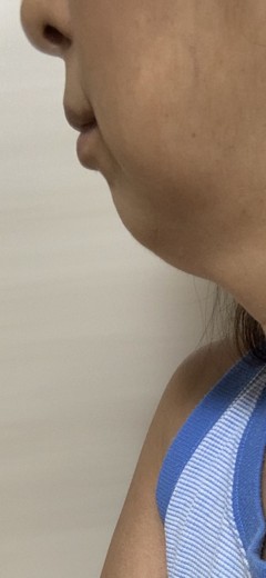 before photo: ハイフ(HIFU)