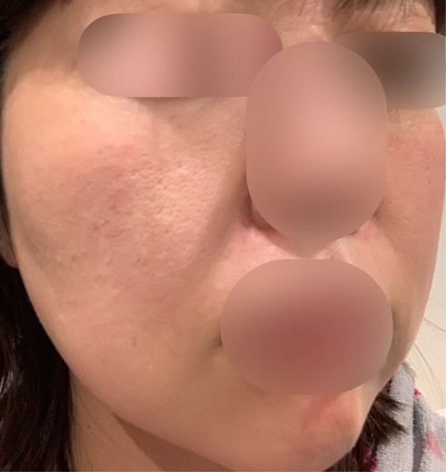 after photo: エレクトロポレーション, ハイフ(HIFU)