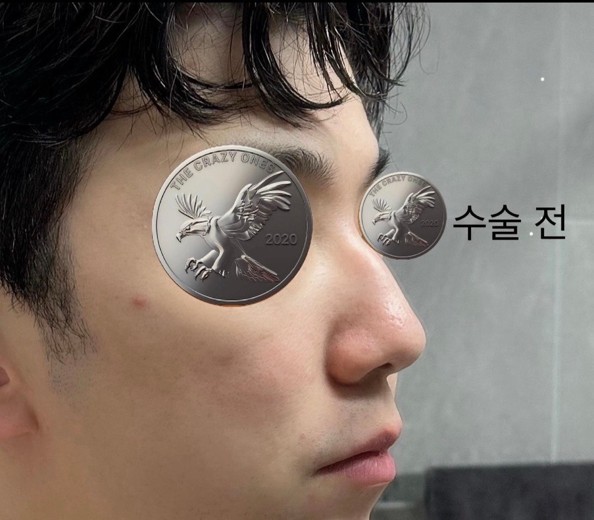 before photo: 콧대(보형물), 코끝(자가연골), 비후성비염수술