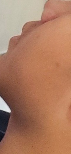 after photo: PDT레이저, 여드름압출