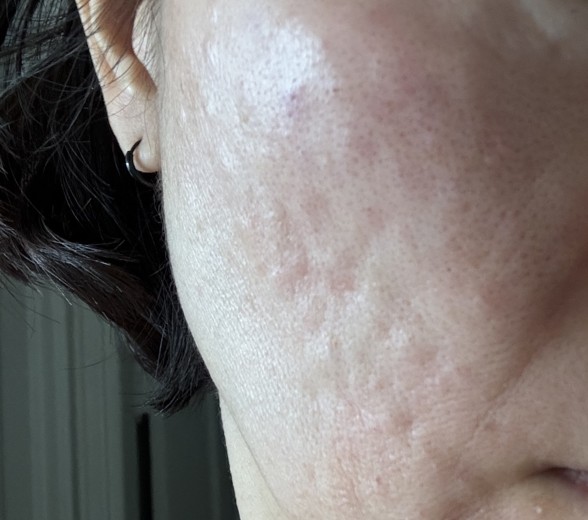 after photo: 리쥬란힐러