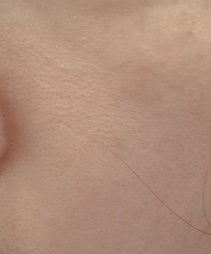 after photo: PRP피부재생술