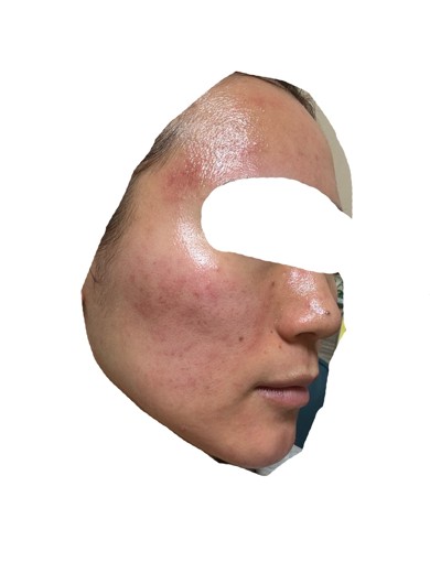 after photo: ダーマペン