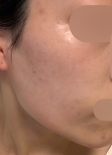 after photo: IPL(光/フォト治療), ルメッカ