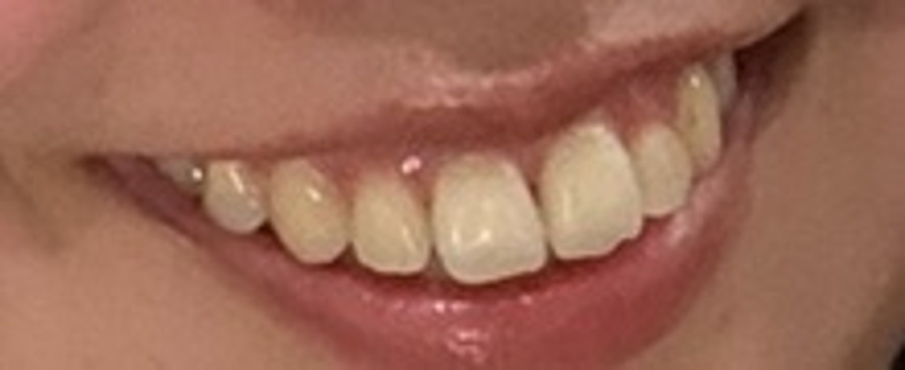 after photo: ホワイトニング