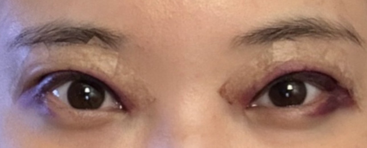 after photo: 눈재수술, 눈매교정