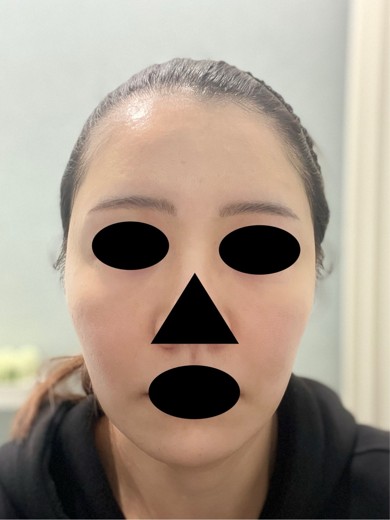 after photo: ボルニューマ