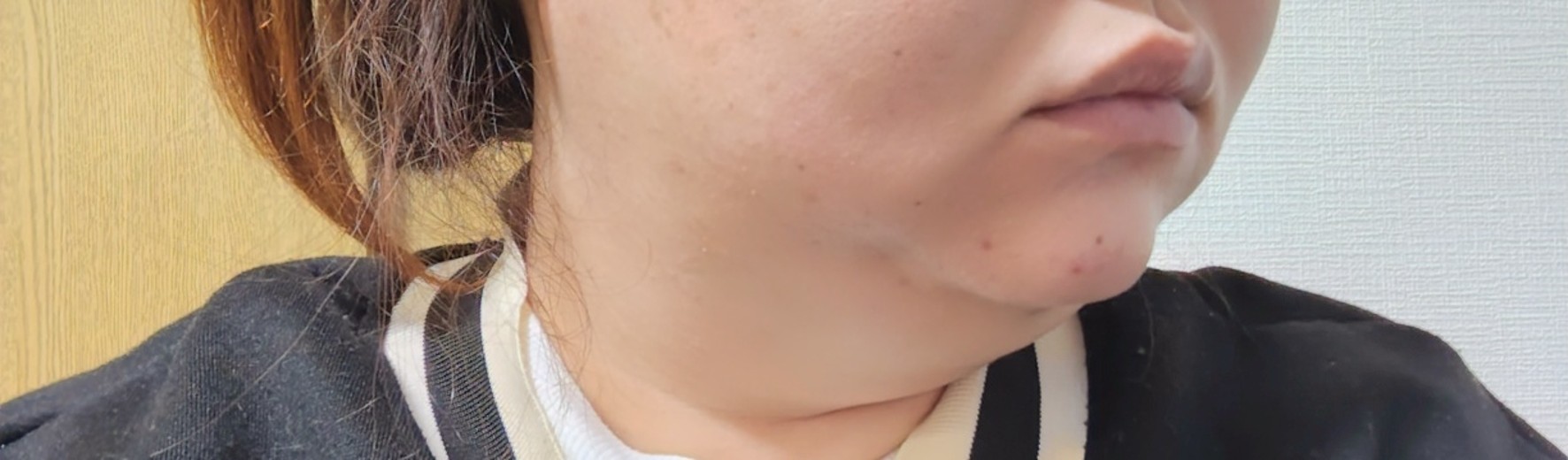 before photo: 脂肪溶解注射(顔)