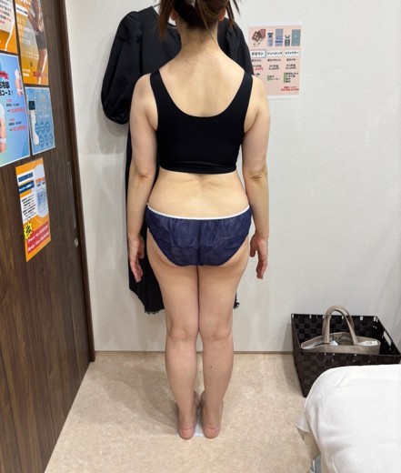 after photo: 脂肪冷却(腹部)