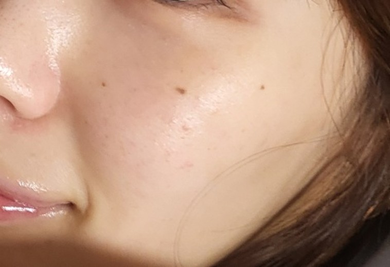 before photo: IPL(光/フォト治療), 診断・検査