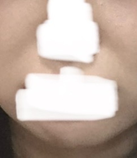 after photo: 팔자주름필러