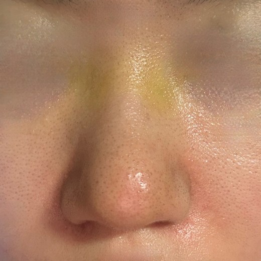 after photo: 콧볼축소, 복코교정(수술)