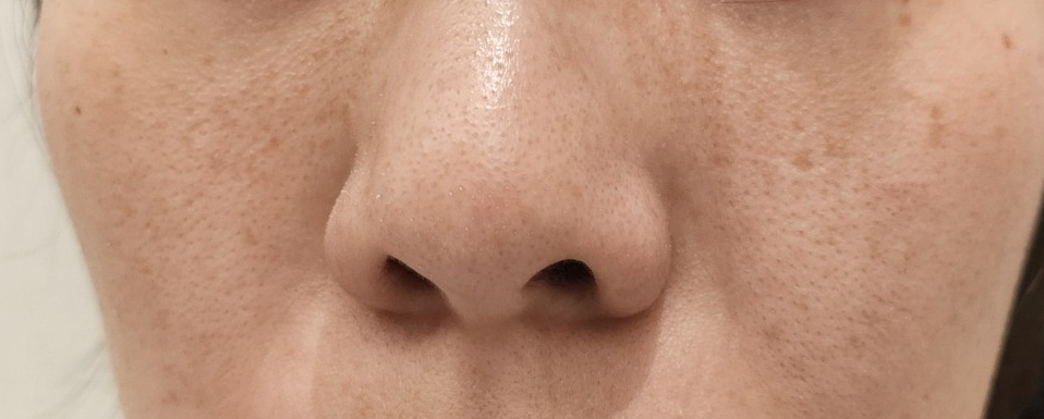 再来OK】ハイドラフェイシャル＋エレクトロポレーション | おおかみ