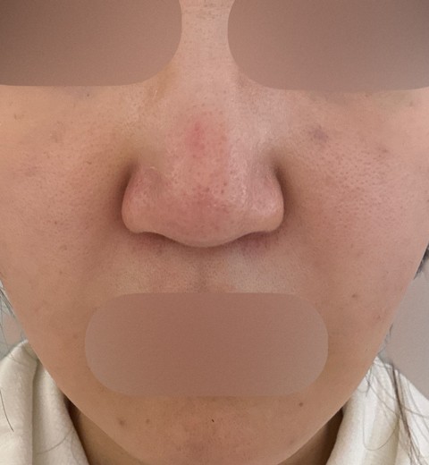 after photo: ジュベルック(Juvelook)