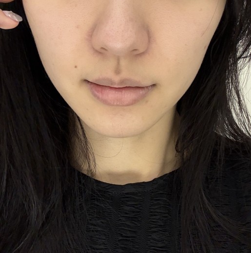 after photo: ダーマペン