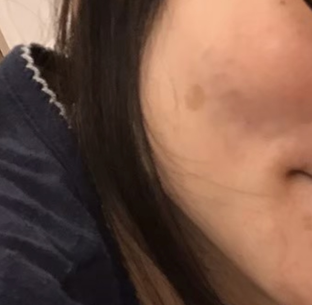 全顔シミ取り放題＋美顔レーザートーニング【1月15日迄にご予約頂いた