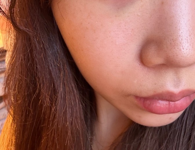before photo: 水光注射, リズネ(LIZNE)