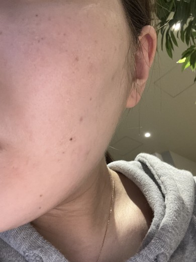 before photo: IPL(光/フォト治療), ハイドラジェントル