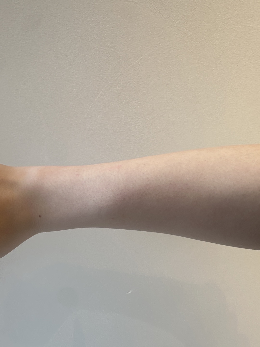 女性限定】全身脱毛｜ジェントルマックスプロ／ジェントルマックスプロ