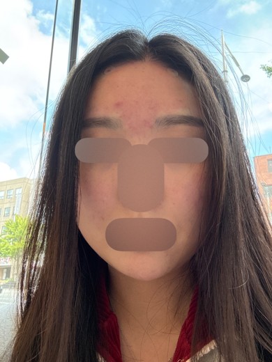 after photo: 인모드리프팅