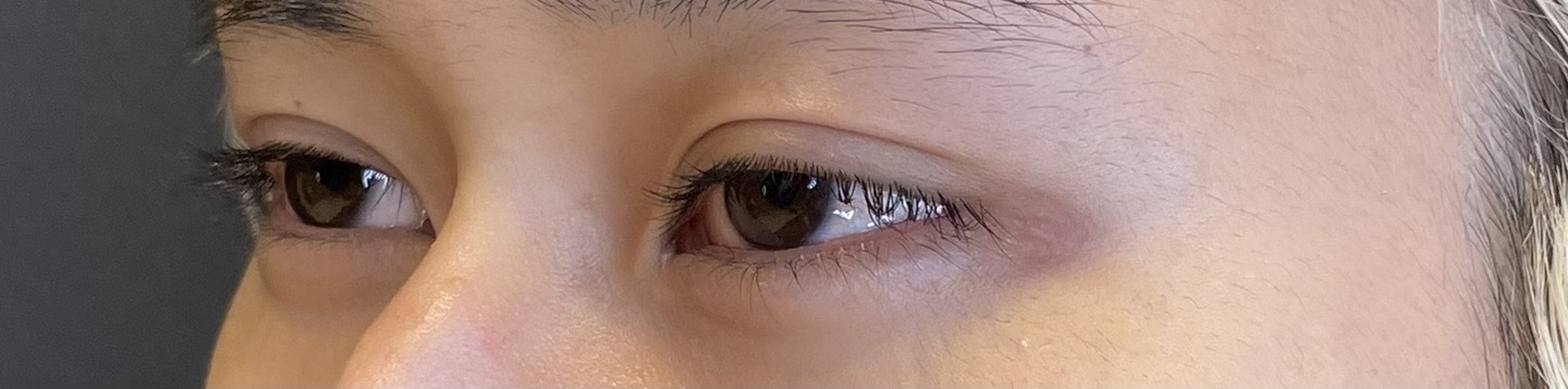 before photo: タレ目形成, 目尻切開