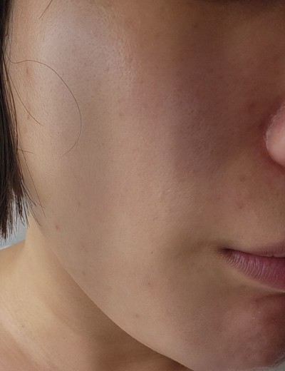 before photo: 앞광대필러