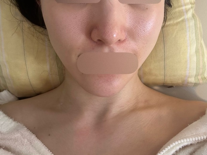 after photo: エレクトロポレーション