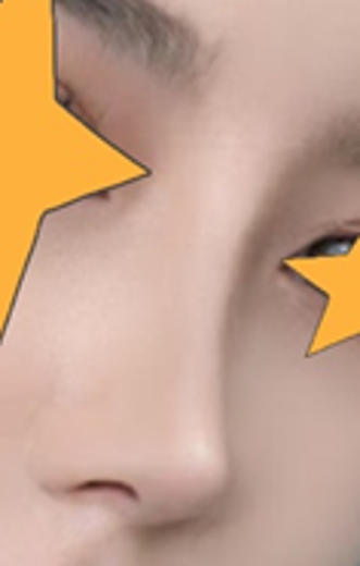 before photo: 코재수술