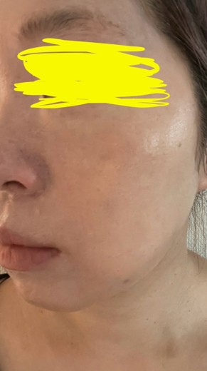 after photo: サーモン注射