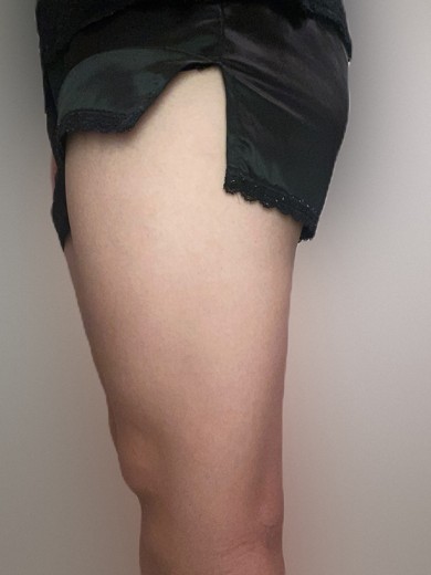 before photo: 脂肪溶解注射(腕), 脂肪溶解注射(太もも)