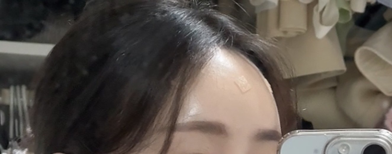 after photo: 이마필러