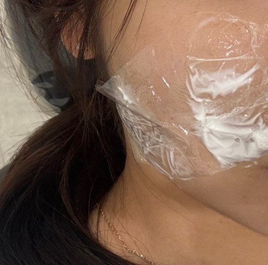 before photo: 윤곽주사, 사각턱보톡스