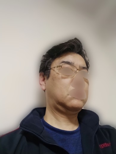 after photo: レーザートーニング