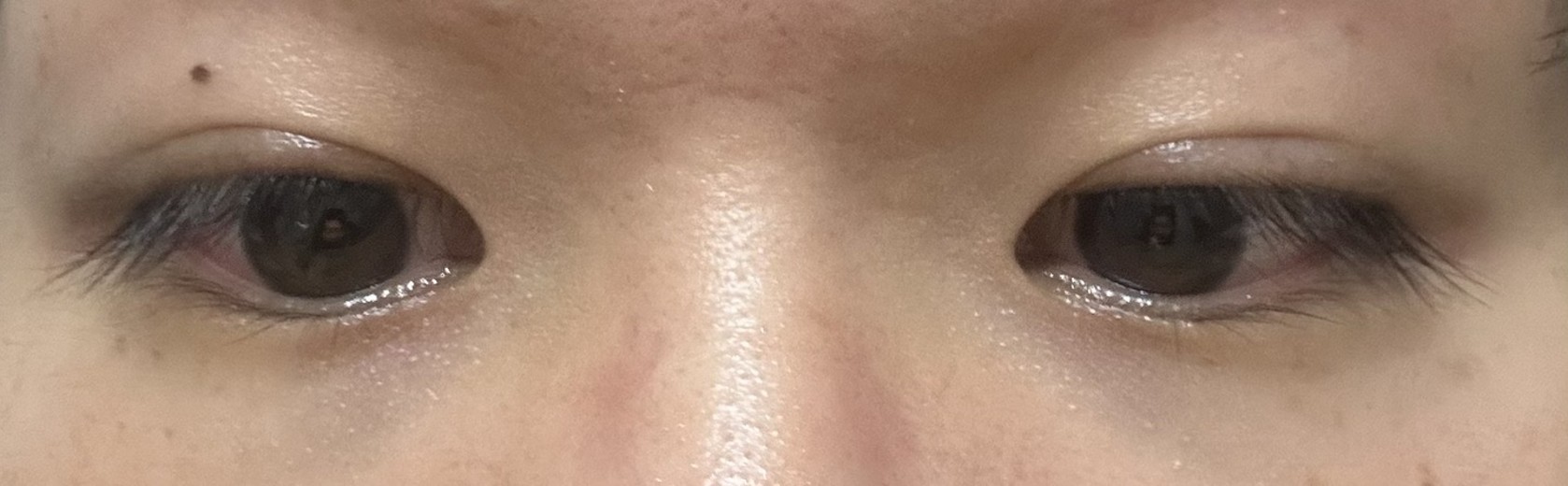 after photo: 眼瞼下垂(目つき矯正)