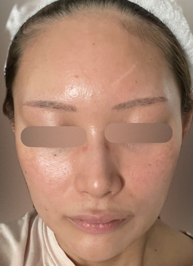 after photo: ジュベルック(Juvelook), サブシジョン(ニキビ跡治療)