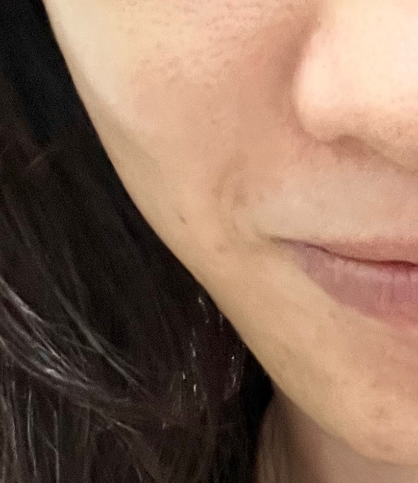 ポテンツァ ダイヤモンドチップ（全顔300ショット）たるみ・引き締めに