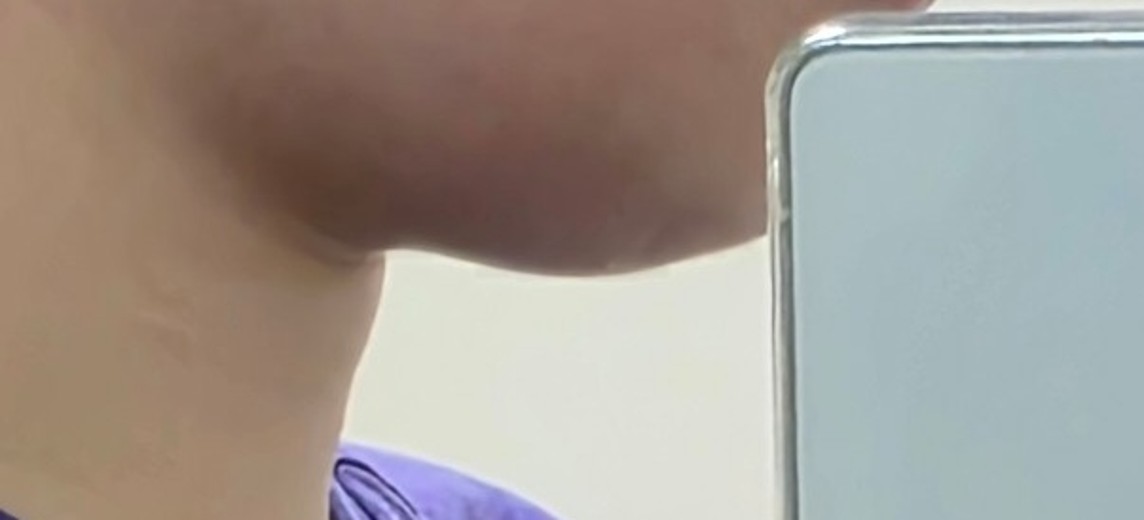 before photo: 인모드리프팅, 윤곽주사, 슈링크리프팅