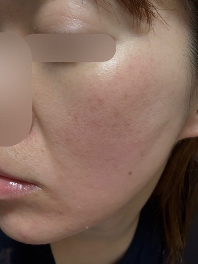 before photo: 糸リフト