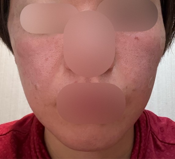 after photo: 糸リフト