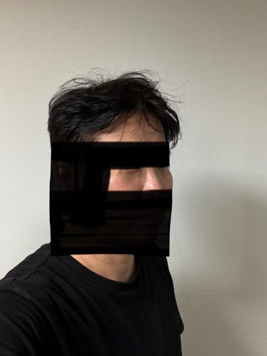 after photo: 눈밑지방재배치