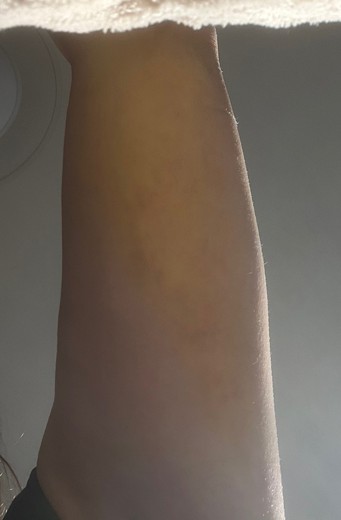 after photo: 脂肪吸引(腕)