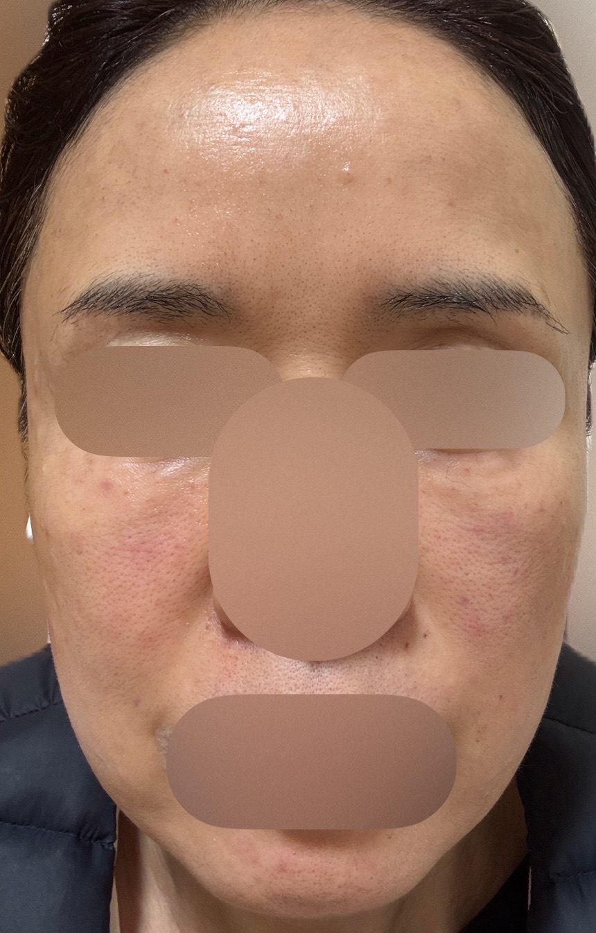 リジュランヒーラー2cc | LORE CLINIC【ロアクリニック】