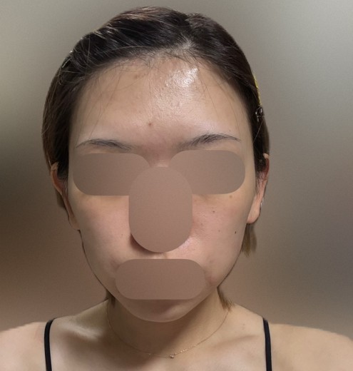 after photo: IPL(光/フォト治療)