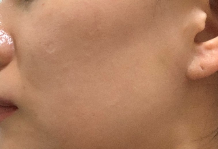 after photo: ピーリング, ルメッカ