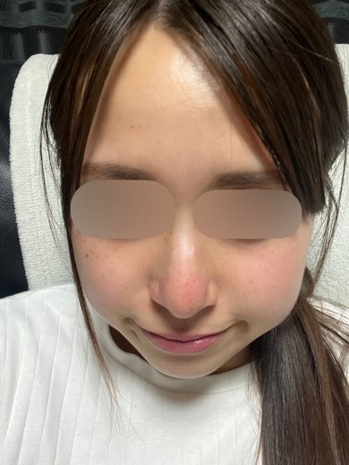 after photo: ダーマペン