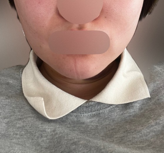 after photo: 脂肪吸引注射