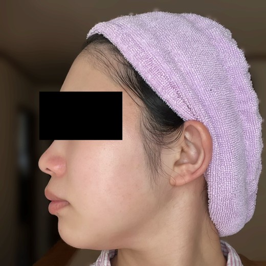 after photo: 脂肪溶解注射(顔)
