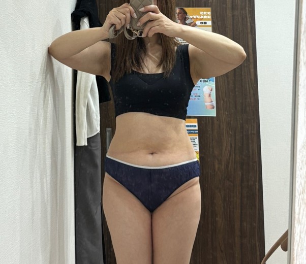 after photo: 脂肪冷却(腹部)