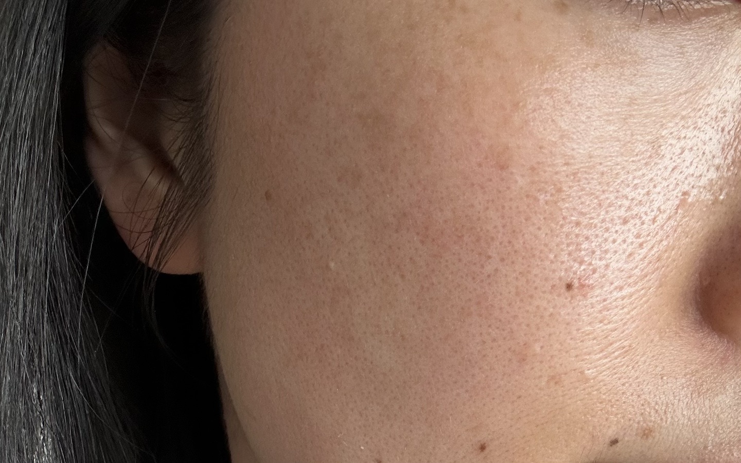 マッサージピール｜即日ハリ・ツヤ・透明感美肌治療【1月15日迄にご