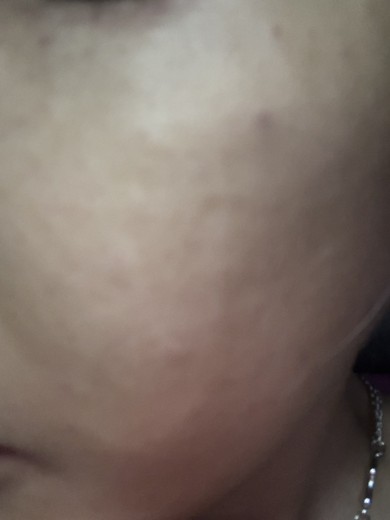 before photo: 리쥬란힐러, 스킨보톡스